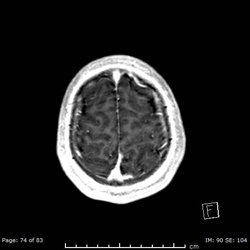 File:Balo concentric sclerosis (Radiopaedia 61637-69636 Axial T1 C+ 74).jpg