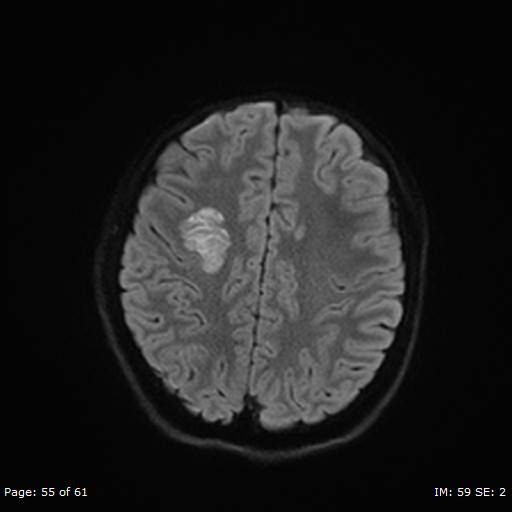 Balo concentric sclerosis (Radiopaedia 61637-69636 I 345).jpg