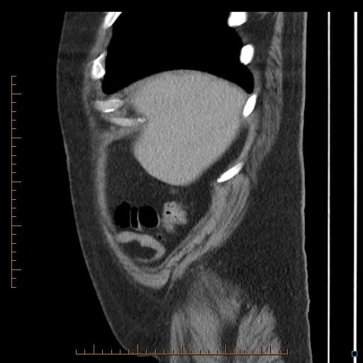 File:Bariatric balloon causing gastric outlet obstruction (Radiopaedia 54449-60672 C 72).jpg