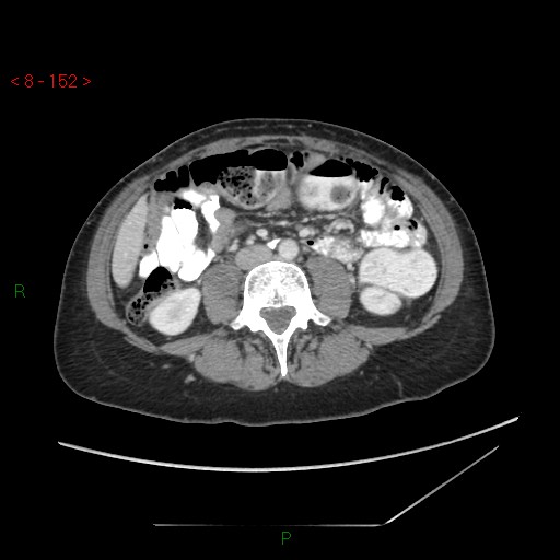 Bartholin gland cyst (Radiopaedia 54904-61181 A 38).jpg