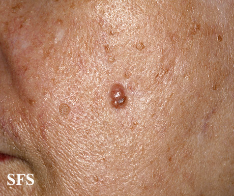 Basal Cell Carcinoma (Dermatology Atlas 215).jpg