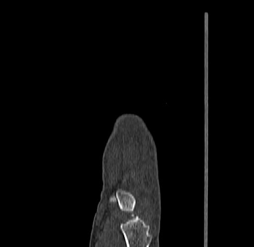 Base of 2nd metacarpal fracture (Radiopaedia 73741-84544 Sagittal bone window 28).jpg