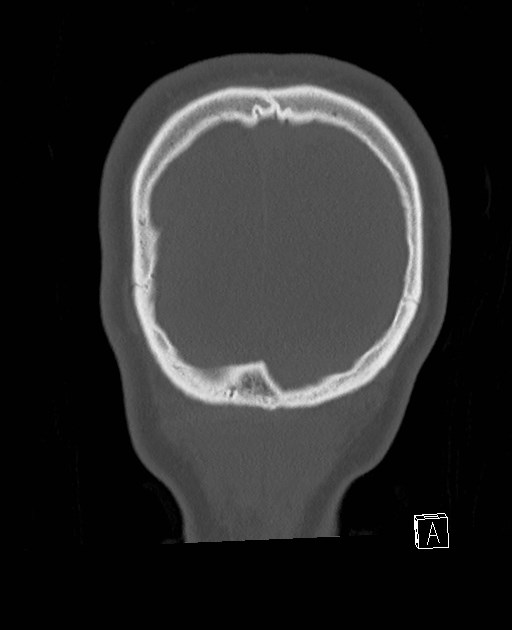 Base of skull fracture with bilateral Le Fort fractures (Radiopaedia 47094-51638 Coronal bone window 10).jpg