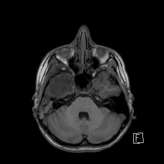 Base of skull rhabdomyosarcoma (Radiopaedia 32196-33142 Axial T1 13).jpg