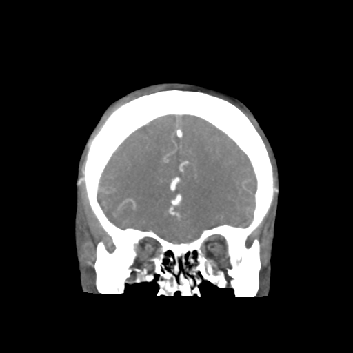 Basilar and bilateral vertebral artery occlusion (Radiopaedia 45592-49723 B 28).png