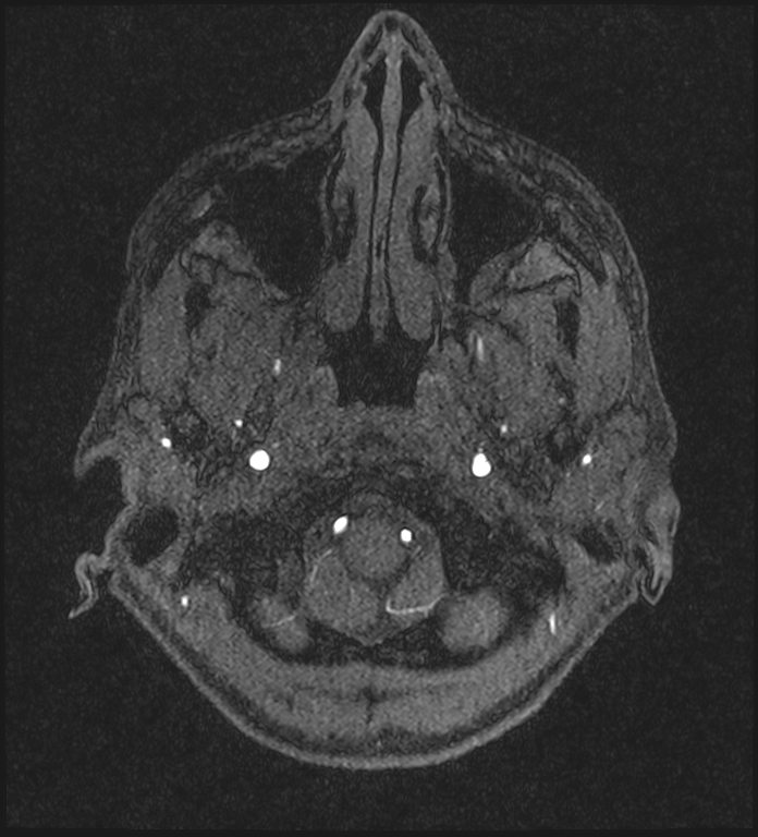 Basilar artery perforator aneurysm (Radiopaedia 82455-97733 Axial MRA 23).jpg