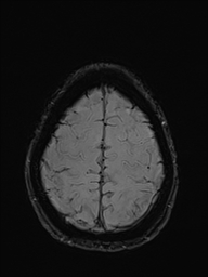 File:Basilar artery perforator aneurysm (Radiopaedia 82455-97733 Axial SWI 52).jpg