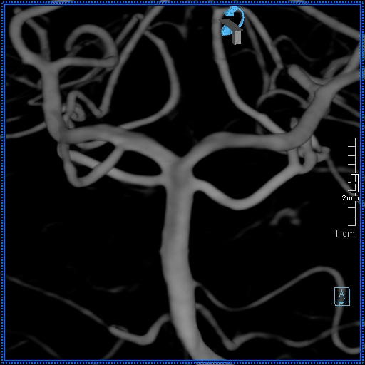 Basilar artery perforator aneurysm (Radiopaedia 82455-99524 3D Left VA 42).jpg