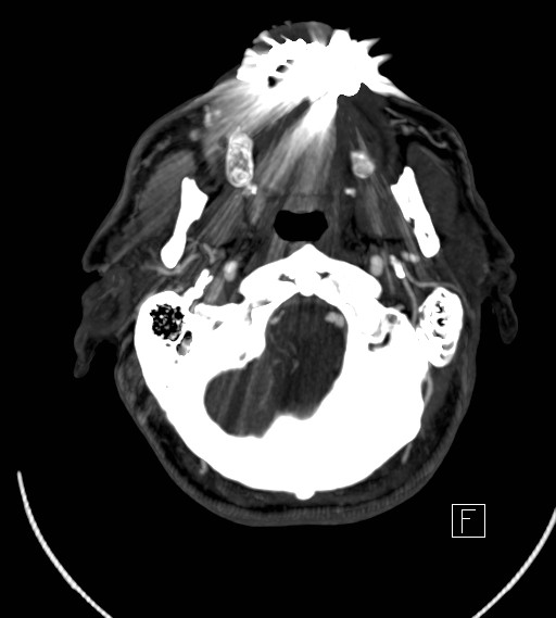 Basilar artery thrombosis (Radiopaedia 26986-27163 A 12).jpg