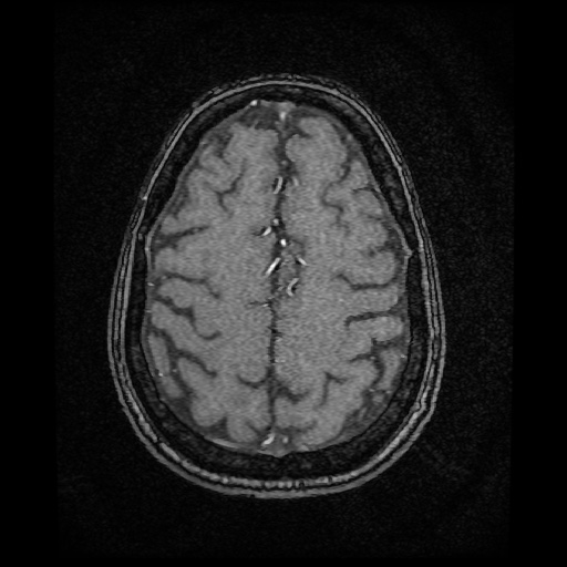 Basilar top and left middle cerebral artery aneurysm (Radiopaedia 61965-70031 Axial MRA 137).jpg