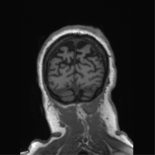 Behavioral variant frontotemporal dementia and late onset schizophrenia (Radiopaedia 52197-58083 Coronal T1 19).png