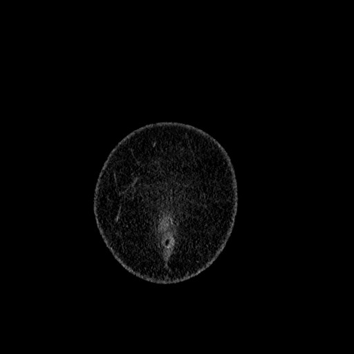 Benign leiomyoma with hydropic features (Radiopaedia 89250-106130 B 1).jpg