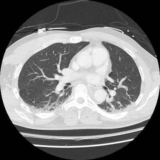 Benign post-traumatic pseudopneumoperitoneum (Radiopaedia 71199-81495 Axial lung window 38).jpg