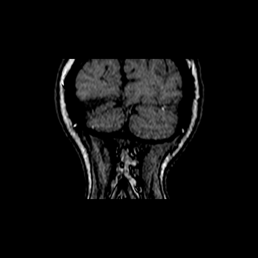 File:Berry aneurysm of the terminal internal carotid artery (Radiopaedia 88286-104918 Coronal TOF 113).jpg