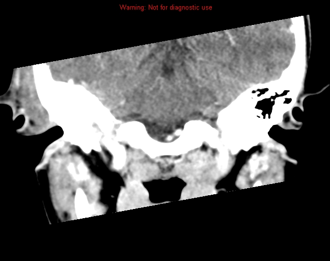 File:Bezold abscess (Radiopaedia 21645-21605 C+ arterial phase 12).jpg