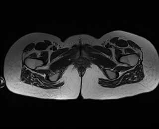 File:Bicornuate bicollis uterus (Radiopaedia 61626-69616 Axial T2 40).jpg