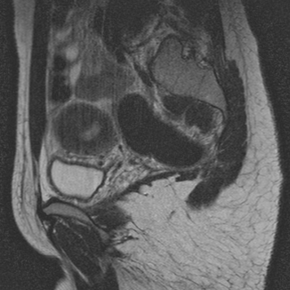 File:Bicornuate uterus (Radiopaedia 24677-24949 B 4).jpg