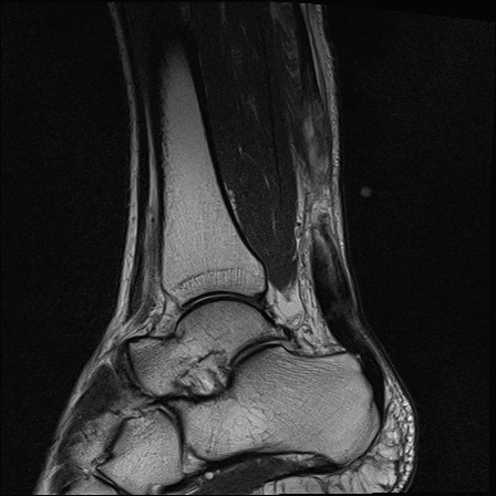 File:Bilateral Achilles tendon complete tear (Radiopaedia 81344-95051 Sagittal T2 23).jpg