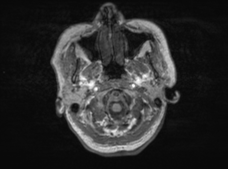 File:Bilateral PCA territory infarction - different ages (Radiopaedia 46200-51784 Axial T1 353).jpg