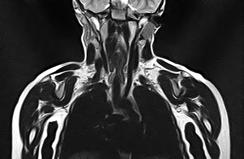 File:Bilateral Sprengel deformity with Klippel-Feil syndrome (Radiopaedia 66395-75650 Coronal T2 11).jpg