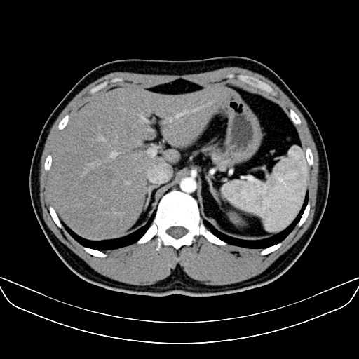 Bilateral accessory renal arteries with mild pelvi-ureteric junction (PUJ) obstruction (Radiopaedia 66357-75596 A 10).jpg