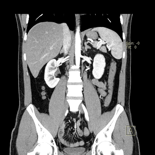 File:Bilateral accessory renal arteries with mild pelvi-ureteric junction (PUJ) obstruction (Radiopaedia 66357-75596 B 23).jpg