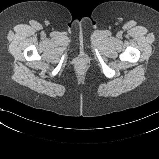 File:Bilateral acetabular protrusion with pincer type femoro-acetabular impingement (Radiopaedia 30134-30733 AXIAL SOFT THIN 109).jpg