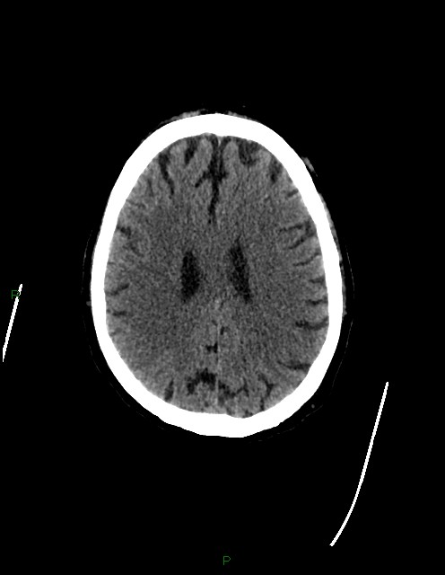 Bilateral acute middle cerebral artery territory infarcts (Radiopaedia 77319-89401 Axial non-contrast 59).jpg