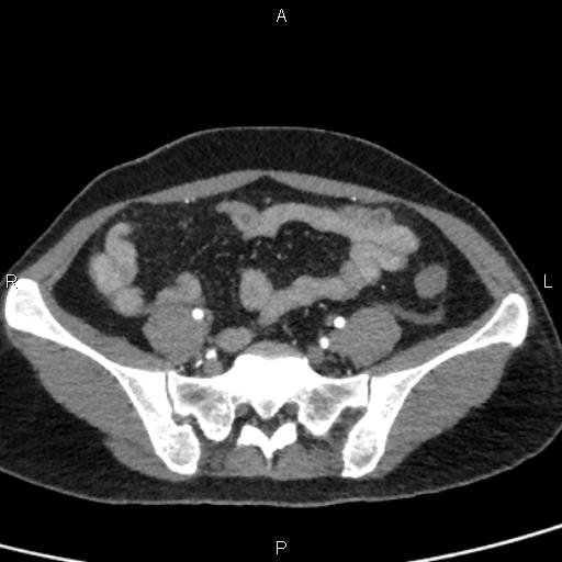 Bilateral adrenal gland hyperenhancement in pancreatitis (Radiopaedia 86642-102753 B 99).jpg