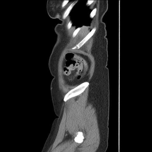 Bilateral adrenal granulocytic sarcomas (chloromas) (Radiopaedia 78375-91007 C 123).jpg