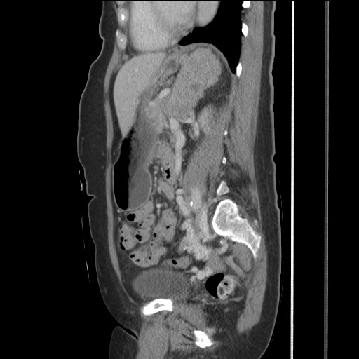 Bilateral adrenal granulocytic sarcomas (chloromas) (Radiopaedia 78375-91007 C 87).jpg