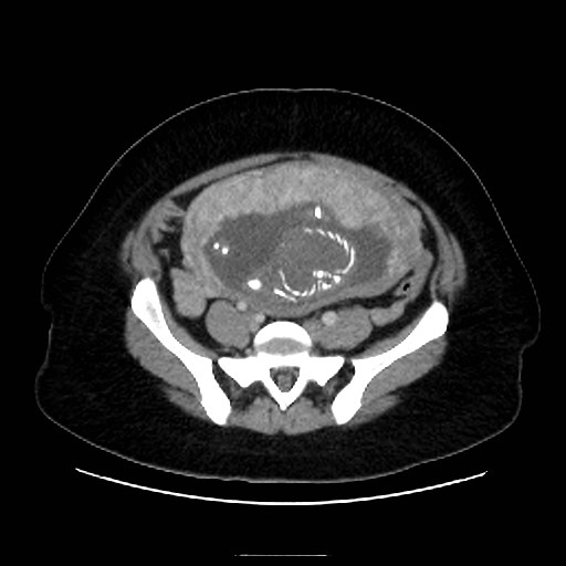 Bilateral adrenal thrombosis (Radiopaedia 58182-65256 A 55).jpg