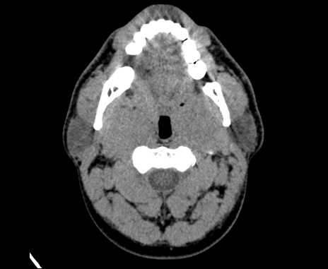 Bilateral carotid body tumors (Radiopaedia 61841-69870 Axial non-contrast 30).jpg