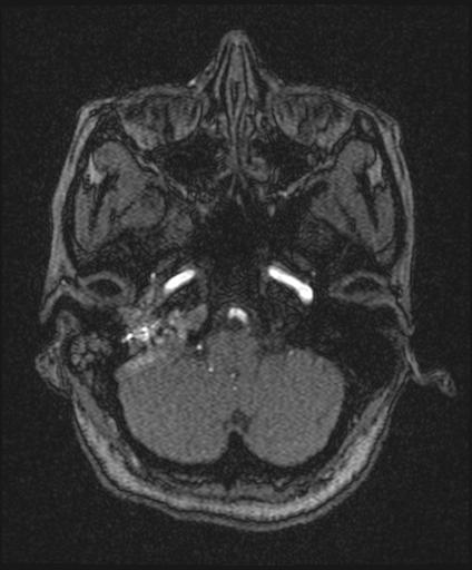 Bilateral carotid body tumors and right glomus jugulare tumor (Radiopaedia 20024-20060 Axial MRA 32).jpg