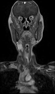 File:Bilateral carotid body tumors and right glomus jugulare tumor (Radiopaedia 20024-20060 MRA 9).jpg