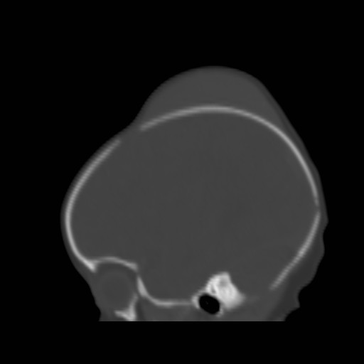 File:Bilateral cephalohematomas and subdural hematomas (Radiopaedia 26778-26929 Sagittal bone window 32).jpg