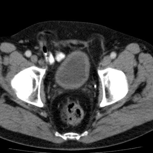 File:Bilateral direct inguinal herniae (Radiopaedia 17016-16719 B 16).jpg