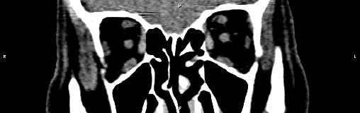 File:Bilateral enlargement of lacrimal glands - sarcoidosis (Radiopaedia 62627-70921 Coronal non-contrast 15).jpg