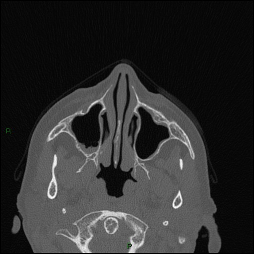 Bilateral frontal mucoceles (Radiopaedia 82352-96454 Axial bone window 201).jpg