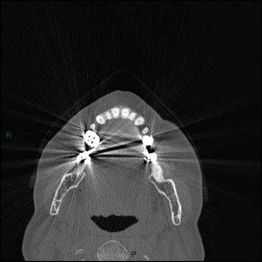 Bilateral frontal mucoceles (Radiopaedia 82352-96454 Axial bone window 272).jpg