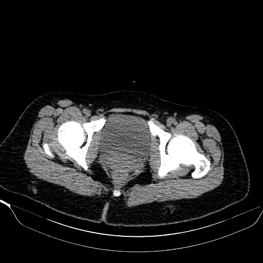 File:Bilateral ovarian dermoid (Radiopaedia 45714-49907 Axial non-contrast 42).JPEG
