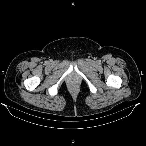 Bilateral ovarian dermoid cysts (Radiopaedia 85785-101603 A 114).jpg