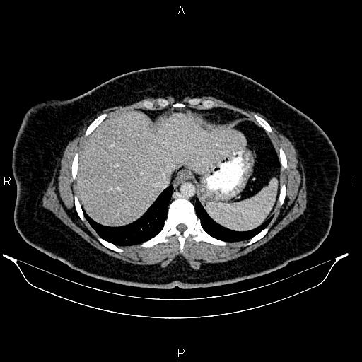 Bilateral ovarian dermoid cysts (Radiopaedia 85785-101603 A 17).jpg