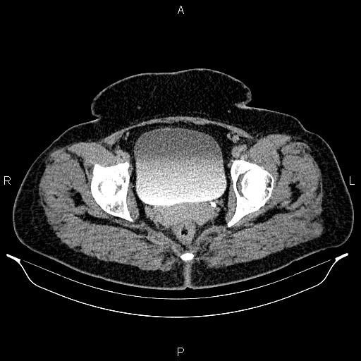 Bilateral ovarian dermoid cysts (Radiopaedia 85785-101603 Axial C+ delayed 80).jpg