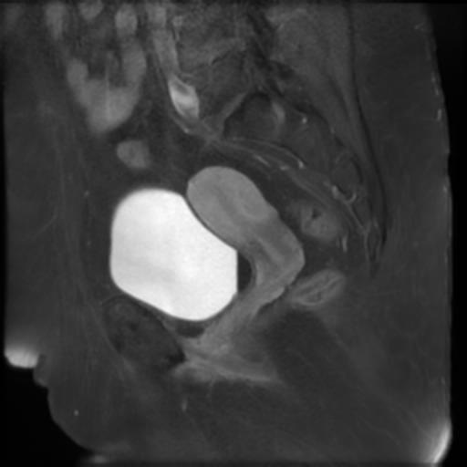 File:Bilateral ovarian dermoid cysts (Radiopaedia 90152-107338 Sagittal T1 C+ 15).jpg