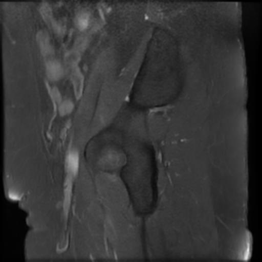 File:Bilateral ovarian dermoid cysts (Radiopaedia 90152-107338 Sagittal T1 C+ 2).jpg