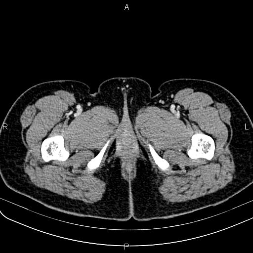 Bilateral ovarian teratoma (Radiopaedia 83131-97503 Axial With contrast 93).jpg