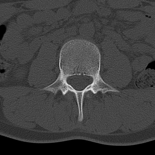 File:Bilateral pars defect (Radiopaedia 26691-26846 Axial bone window 3).jpg