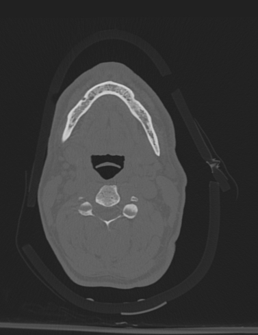 Bilateral perched facet joint (Radiopaedia 63149-71669 Axial bone window 21).jpg