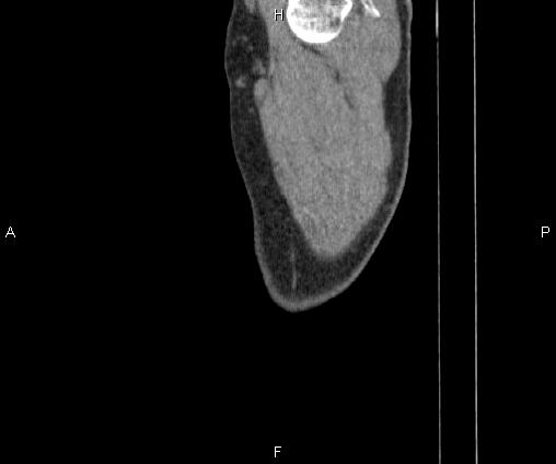Bilateral pulmonary AVM (Radiopaedia 83134-97505 D 115).jpg